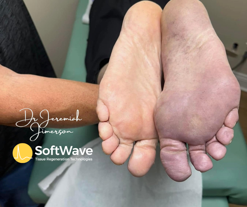 Looking for Peripheral Neuropathy Relief Pain Relief? Discover the Power of SoftWave Tissue Regeneration Technology with Dr. Jeremiah Jimerson in Charleston, SC